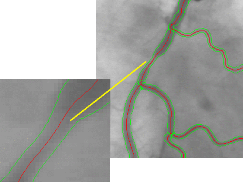 Angiography